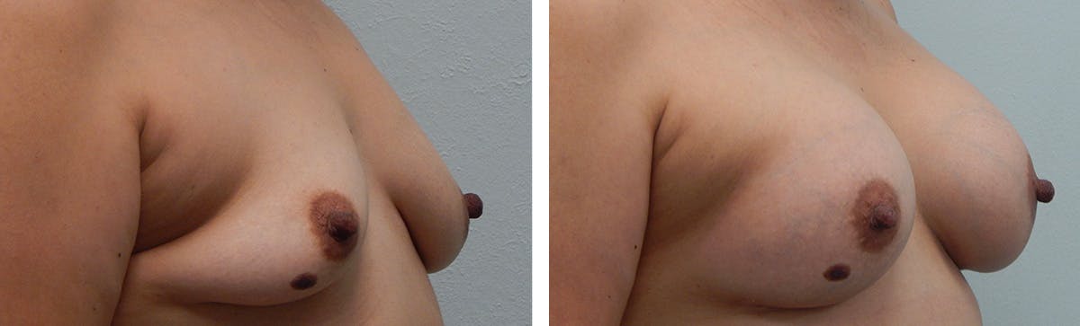Breast Augmentation Before & After Gallery - Patient 192935 - Image 2