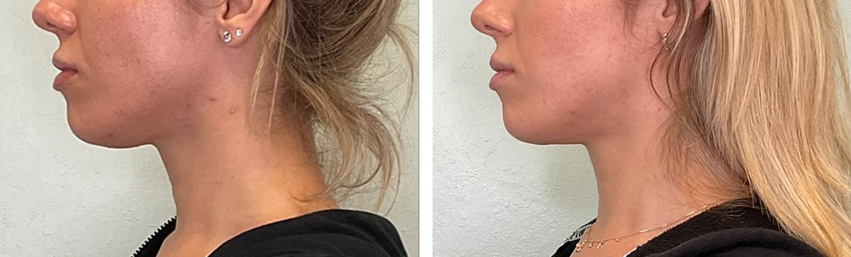Submental Liposuction Before & After Gallery - Patient 166755 - Image 4