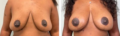Breast Augmentation Before & After Gallery - Patient 296610 - Image 1