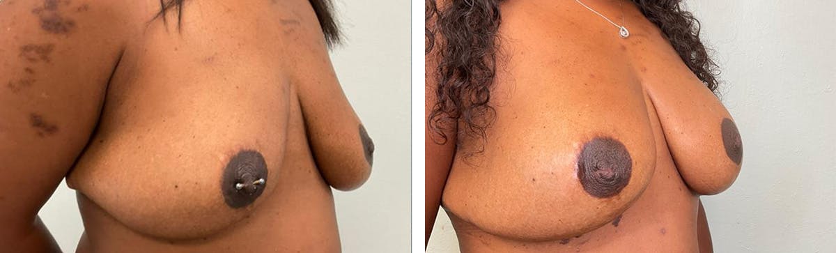 Breast Augmentation Before & After Gallery - Patient 296610 - Image 2