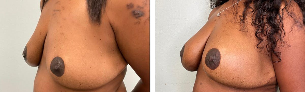 Breast Augmentation Before & After Gallery - Patient 296610 - Image 4