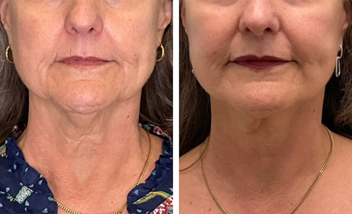Modified Neck Lift Before & After Gallery - Patient 371645 - Image 1