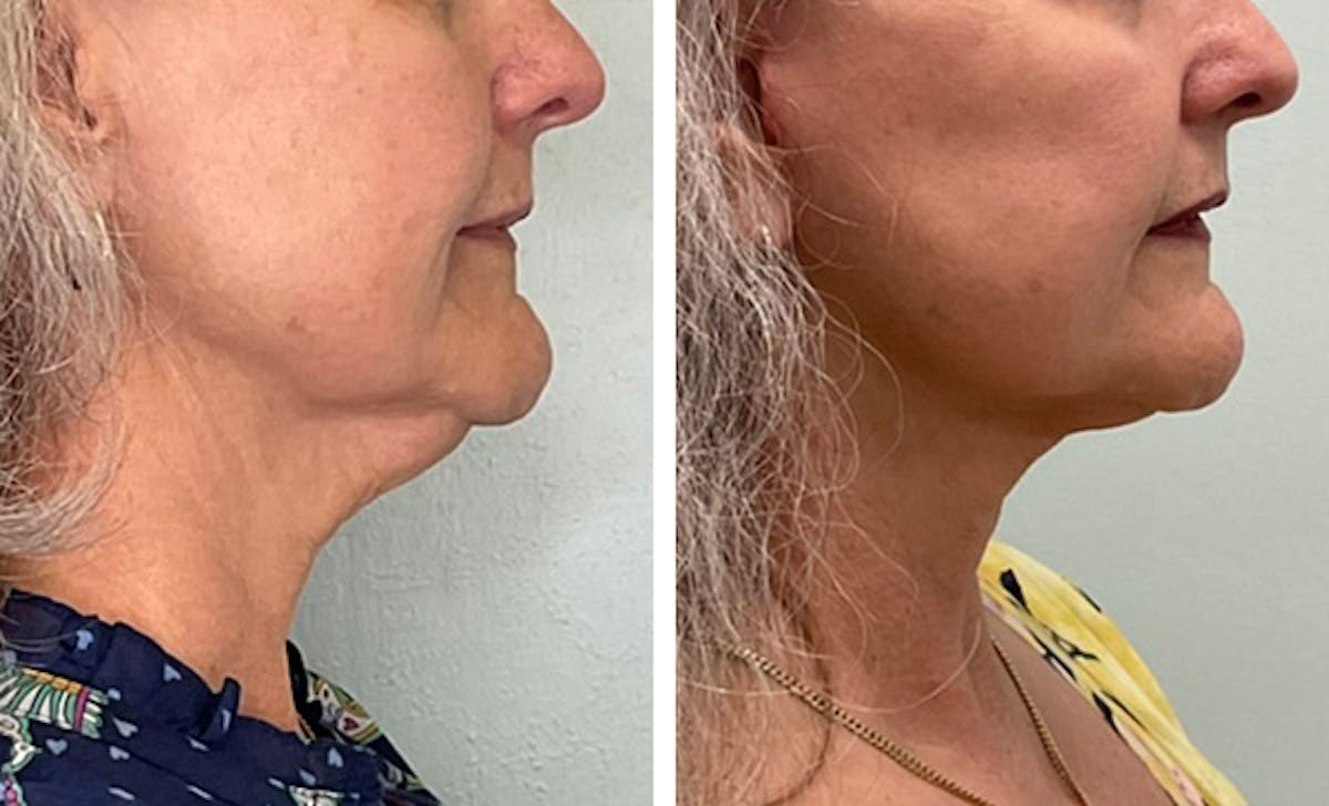 Modified Neck Lift Before & After Gallery - Patient 371645 - Image 3