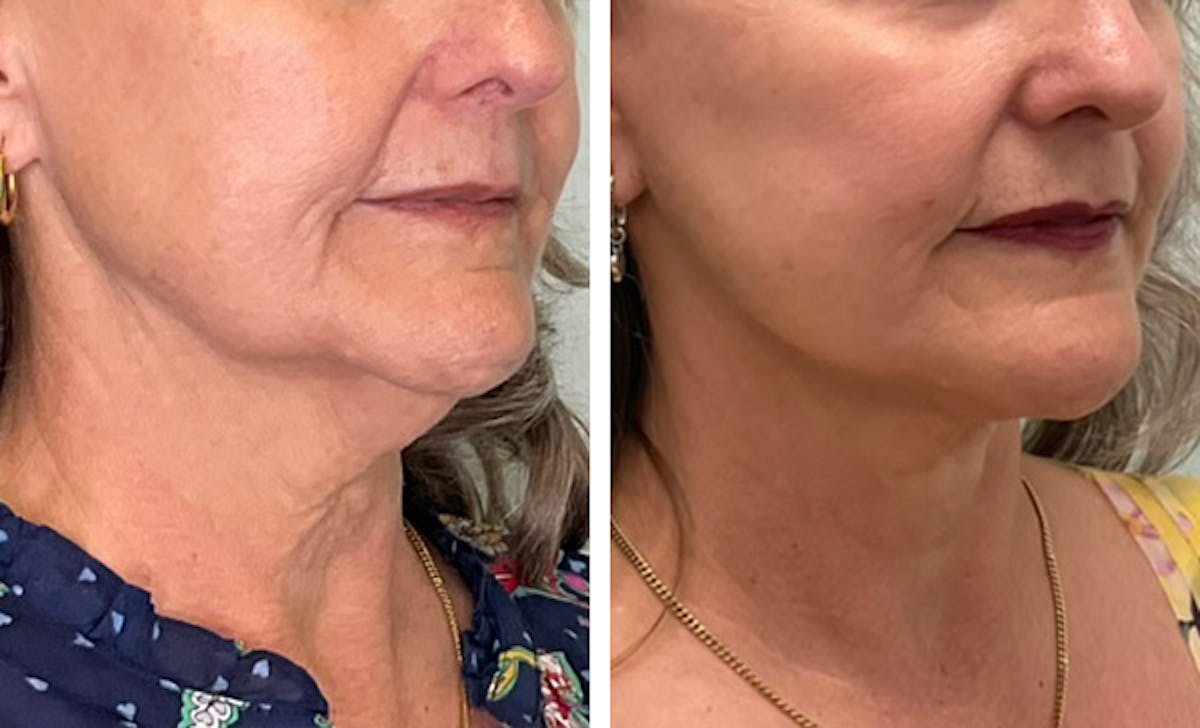 Modified Facelift Before & After Gallery - Patient 144685 - Image 2