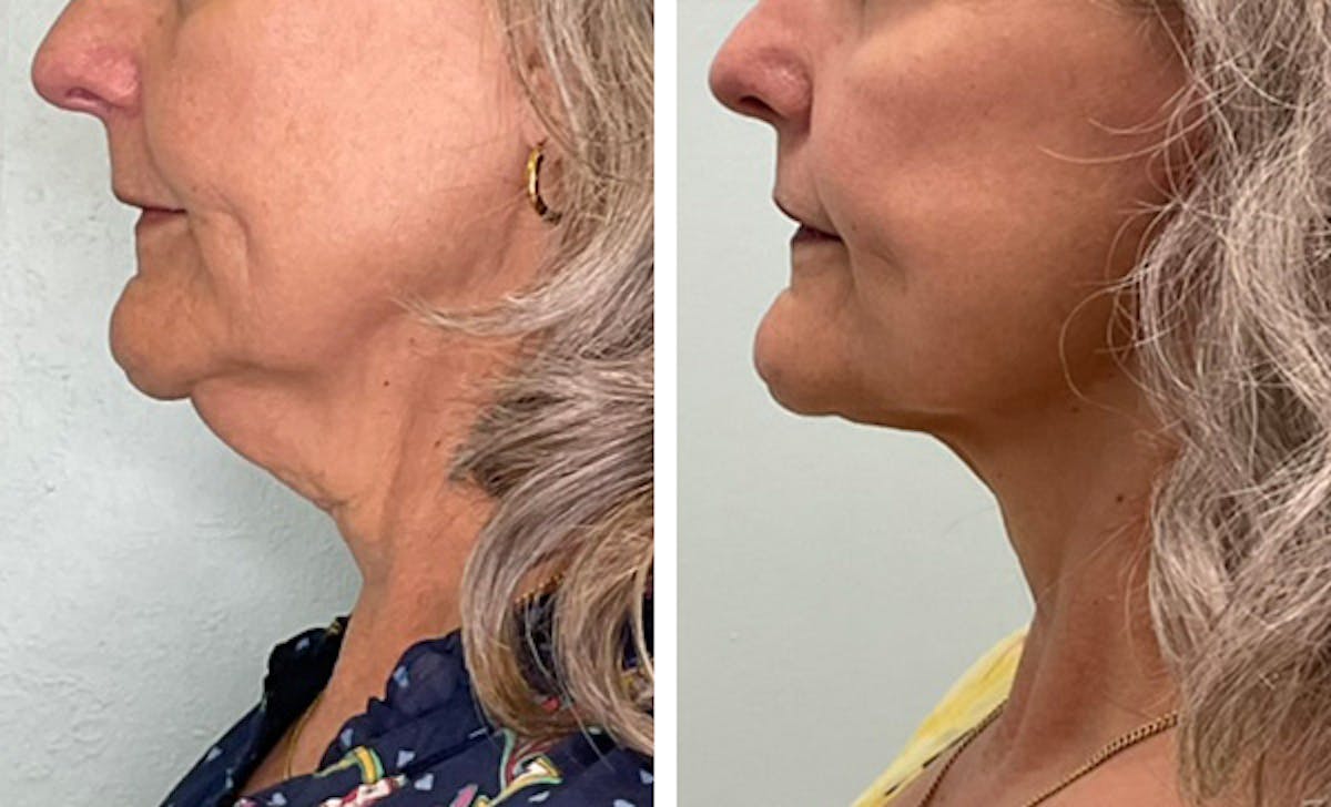 Modified Facelift Before & After Gallery - Patient 144685 - Image 5