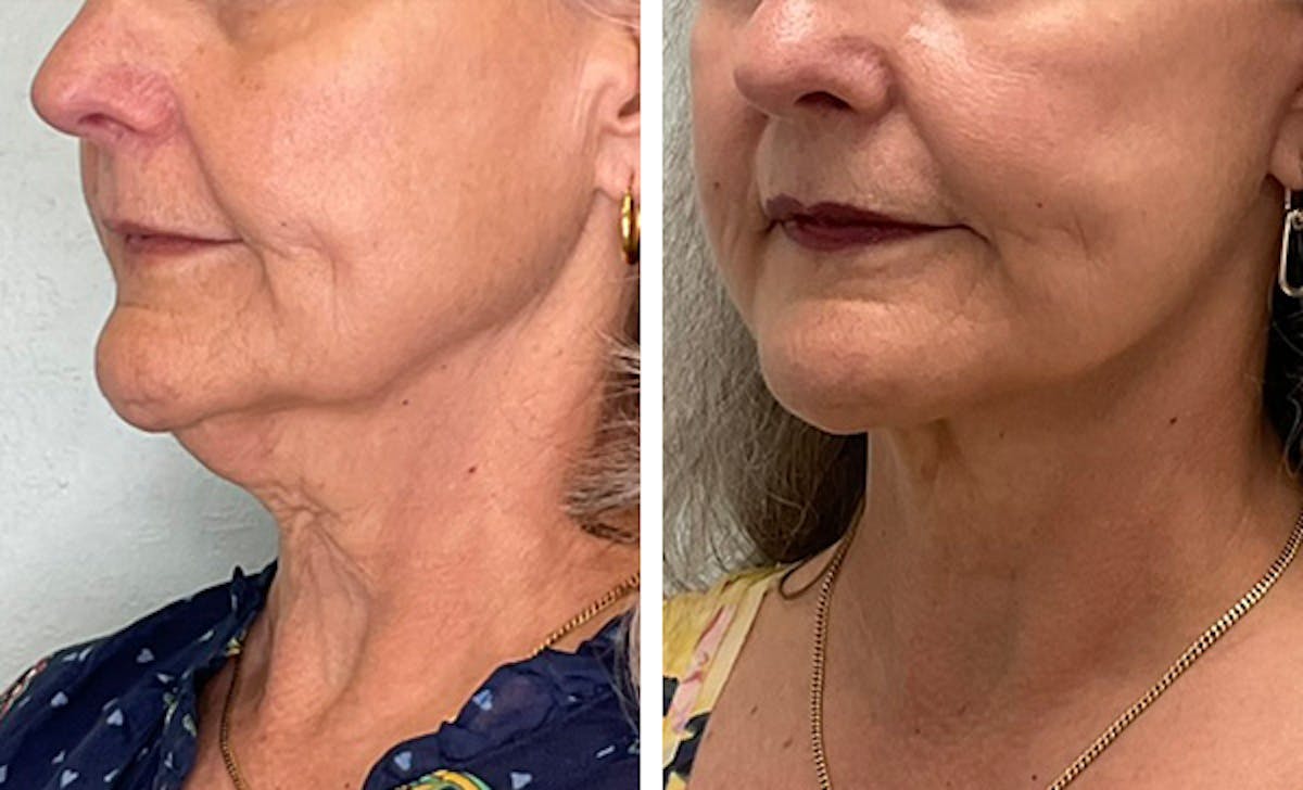 Modified Neck Lift Before & After Gallery - Patient 371645 - Image 4