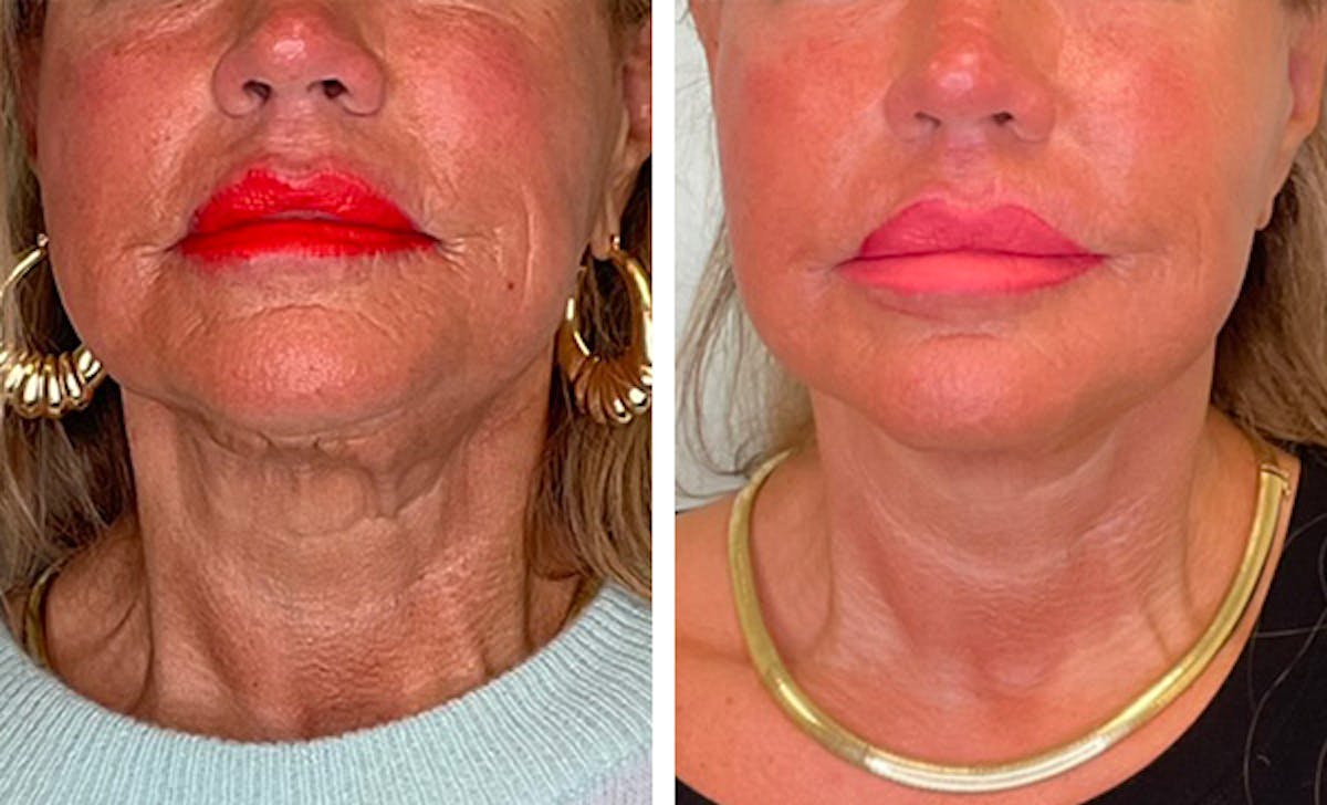 Modified Neck Lift Before & After Gallery - Patient 149493 - Image 1