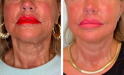 Modified Neck Lift Before & After Gallery - Patient 149493 - Image 1