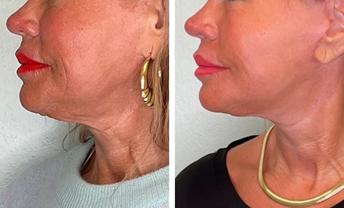 Modified Neck Lift Before & After Gallery - Patient 149493 - Image 3