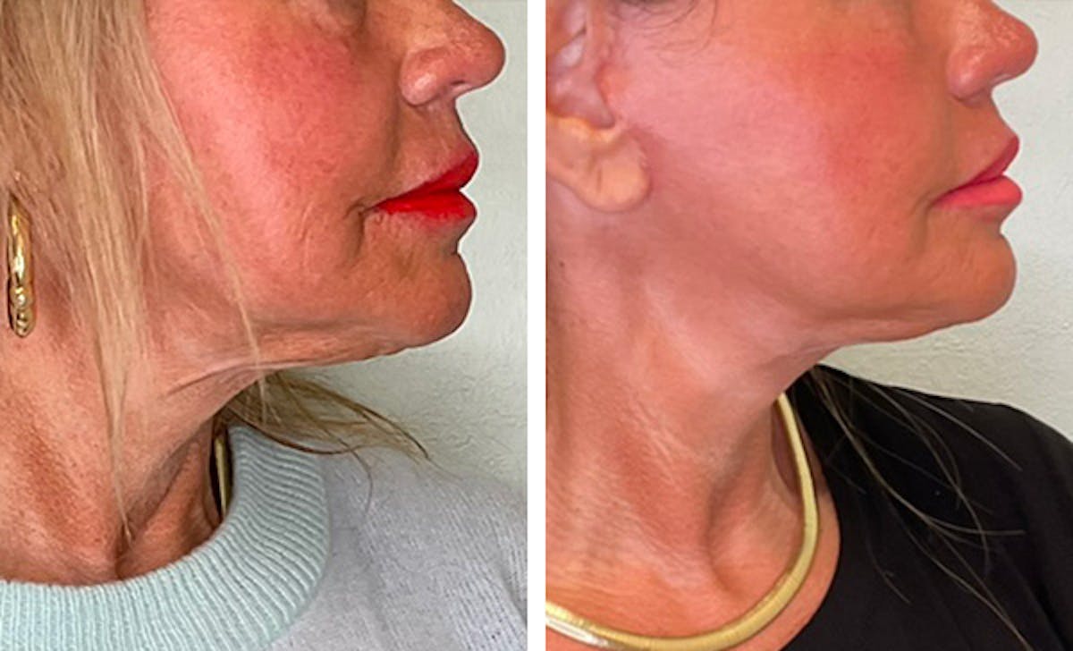 Modified Facelift Before & After Gallery - Patient 165642 - Image 2
