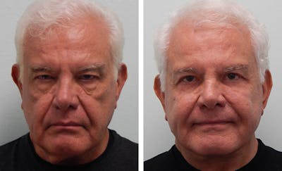 Facelift Before & After Gallery - Patient 176795150 - Image 1