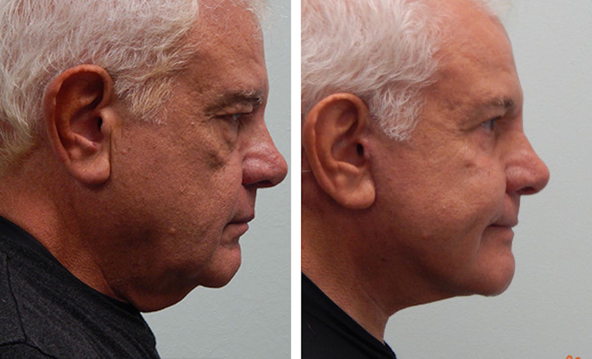 Facelift Before & After Gallery - Patient 176795150 - Image 3