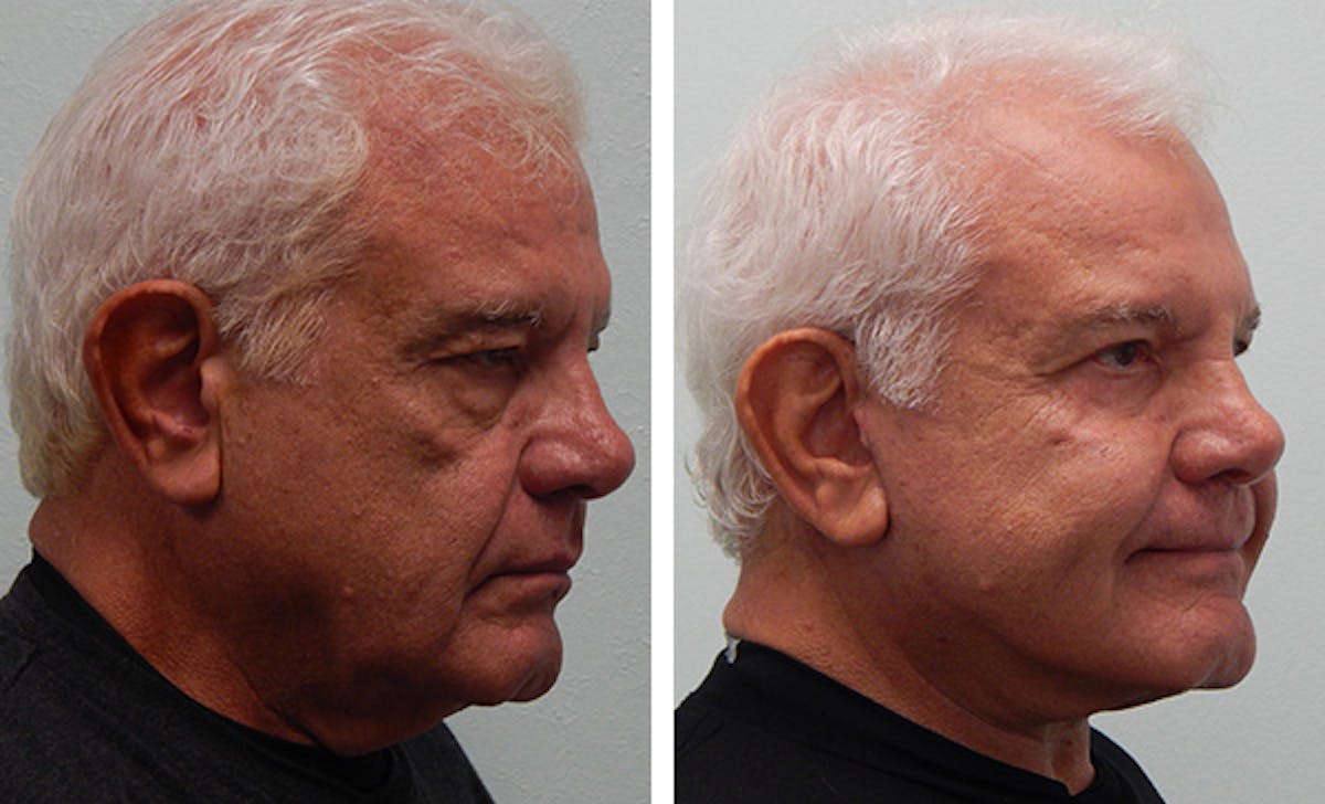 Facelift Before & After Gallery - Patient 176795150 - Image 2