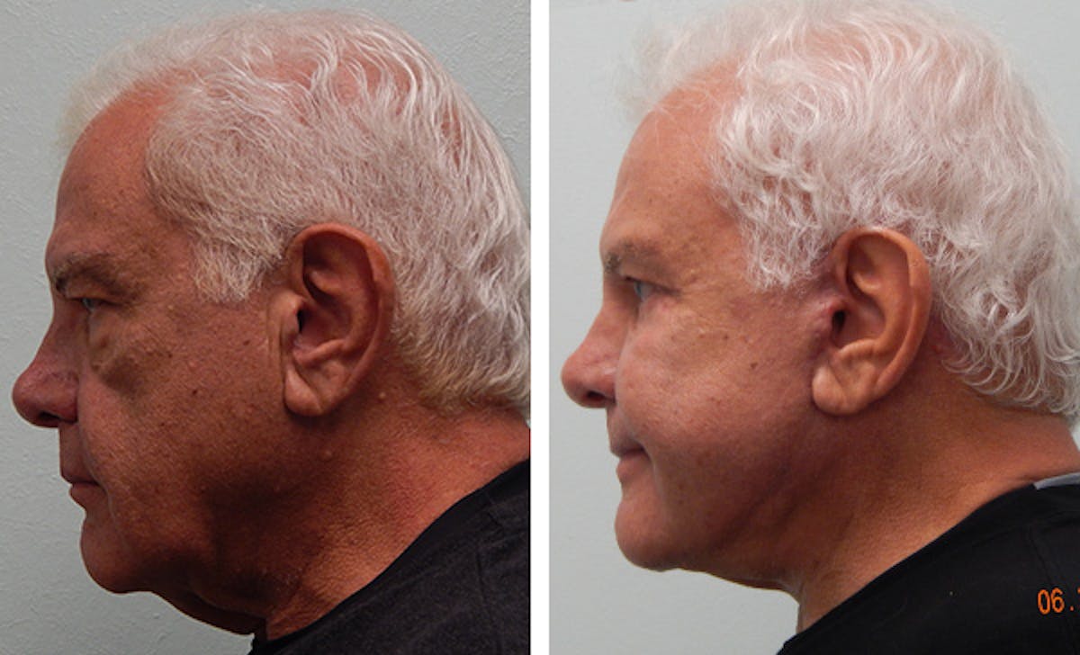 Facelift Before & After Gallery - Patient 176795150 - Image 5