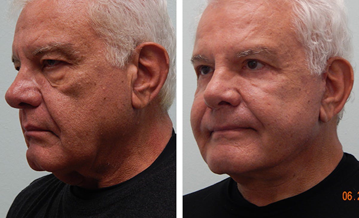 Facelift Before & After Gallery - Patient 176795150 - Image 4