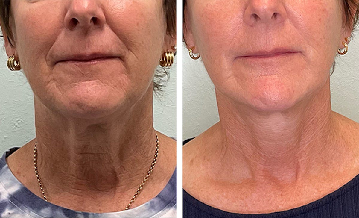 Modified Facelift Before & After Gallery - Patient 332871 - Image 1
