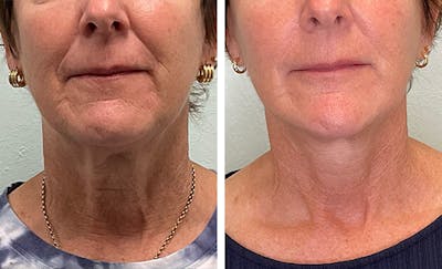 Modified Neck Lift Before & After Gallery - Patient 628893 - Image 1