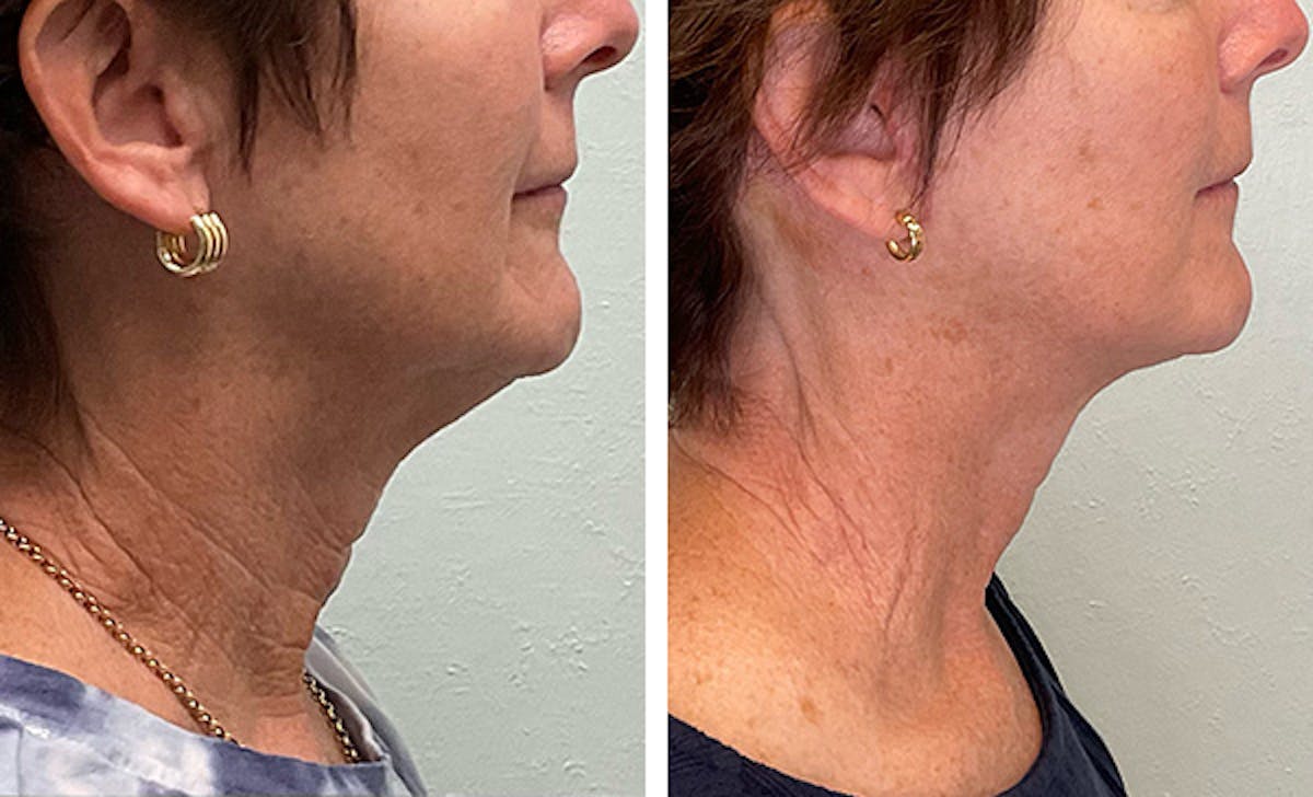 Modified Neck Lift Before & After Gallery - Patient 628893 - Image 3