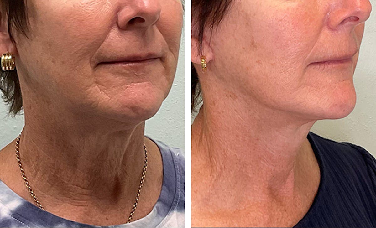 Modified Facelift Before & After Gallery - Patient 332871 - Image 2