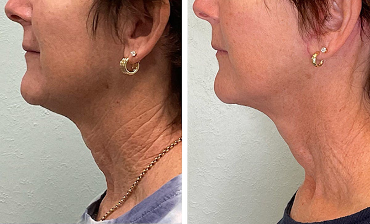 Modified Facelift Before & After Gallery - Patient 332871 - Image 5