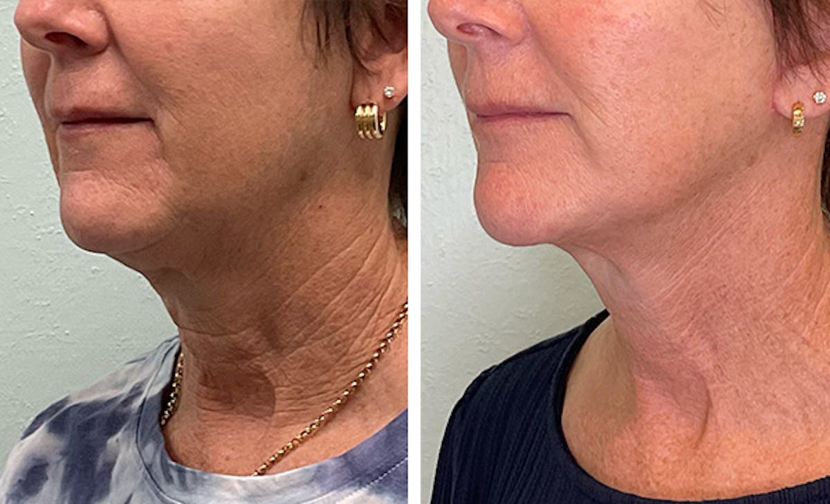 Modified Facelift Before & After Gallery - Patient 332871 - Image 4