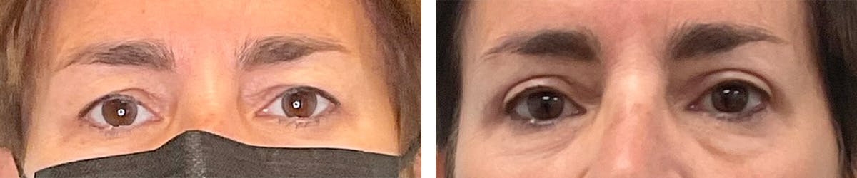 Eyelid Surgery Before & After Gallery - Patient 131978 - Image 1