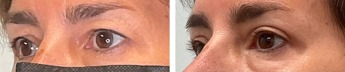 Eyelid Surgery Before & After Gallery - Patient 131978 - Image 3