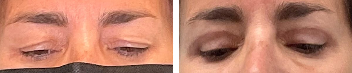 Eyelid Surgery Before & After Gallery - Patient 131978 - Image 2