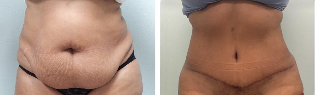 Tummy Tuck Before & After Gallery - Patient 370149 - Image 1