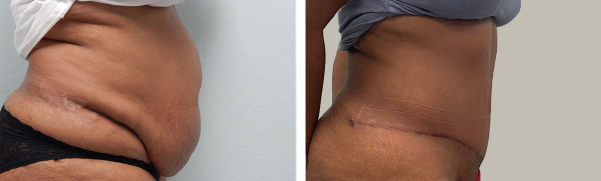 Liposuction Before & After Gallery - Patient 394420 - Image 3