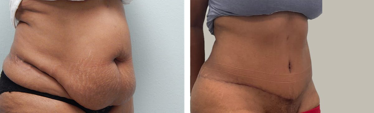 Tummy Tuck Before & After Gallery - Patient 370149 - Image 2