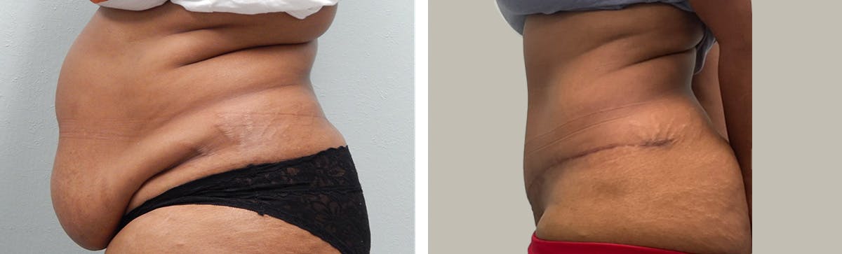 Liposuction Before & After Gallery - Patient 394420 - Image 5