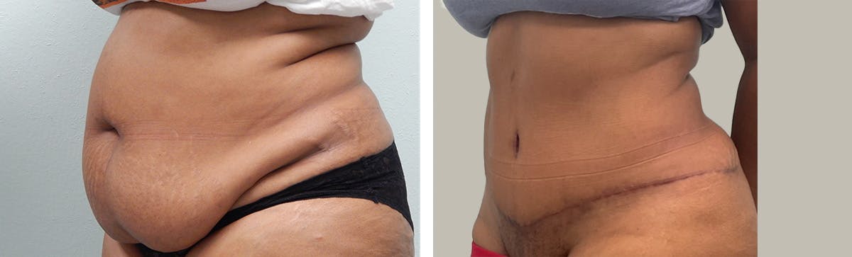 Liposuction Before & After Gallery - Patient 394420 - Image 4