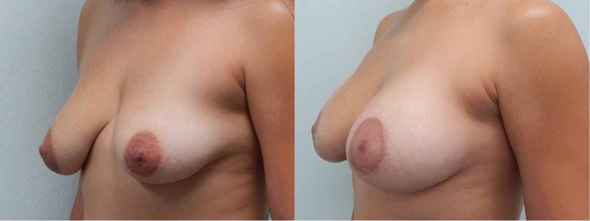 Breast Lift Before & After Gallery - Patient 146805 - Image 3