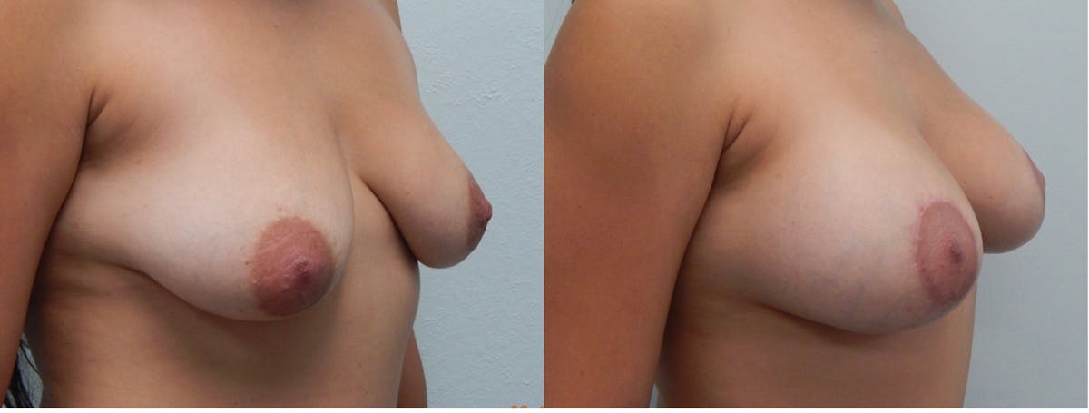 Breast Lift Before & After Gallery - Patient 146805 - Image 2