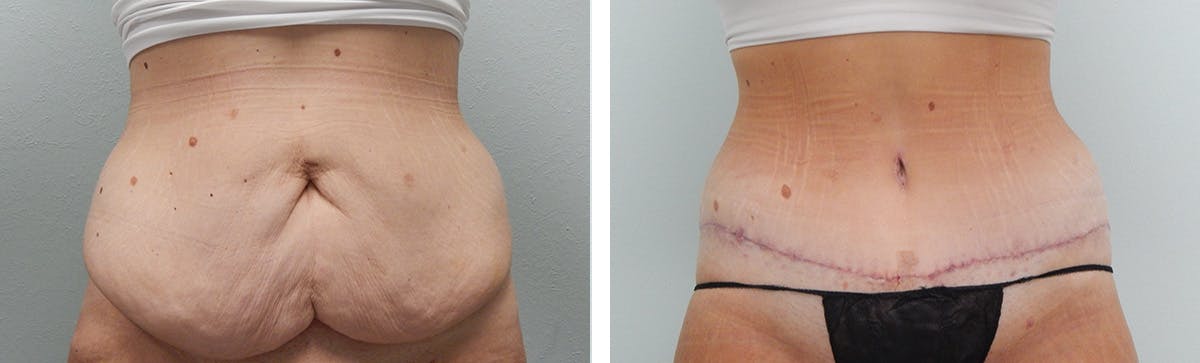 Tummy Tuck Before & After Gallery - Patient 231245 - Image 1
