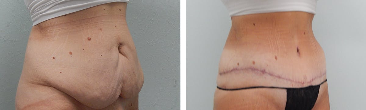 Tummy Tuck Before & After Gallery - Patient 231245 - Image 2