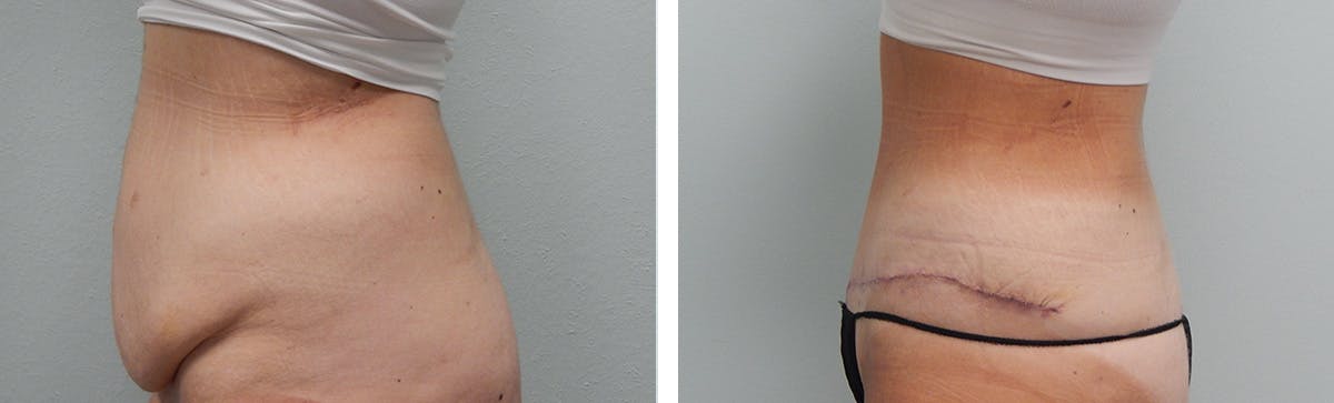 Tummy Tuck Before & After Gallery - Patient 231245 - Image 6