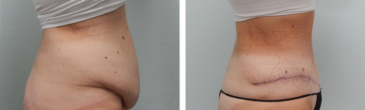 Tummy Tuck Before & After Gallery - Patient 231245 - Image 4