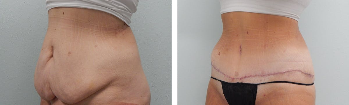 Tummy Tuck Before & After Gallery - Patient 231245 - Image 5