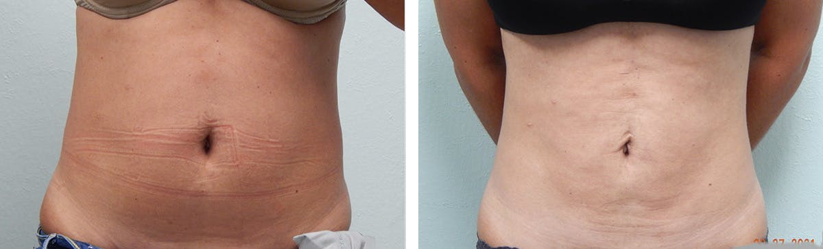 Liposuction Before & After Gallery - Patient 335932 - Image 1