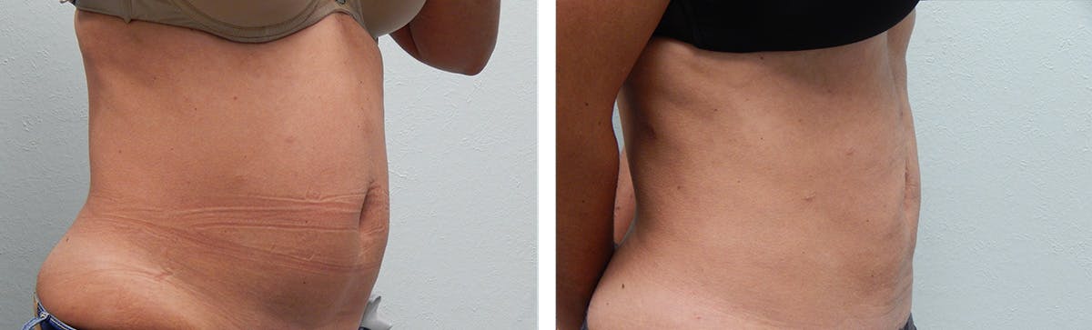 Liposuction Before & After Gallery - Patient 335932 - Image 2