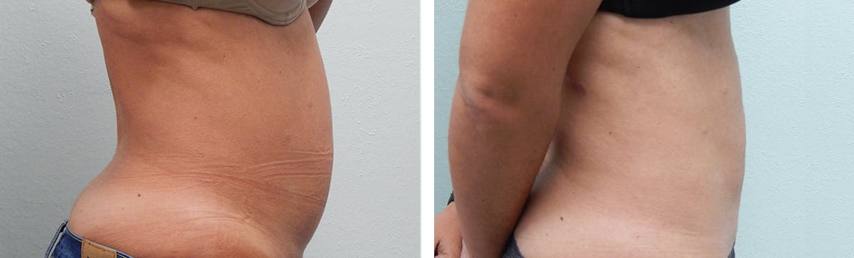 Liposuction Before & After Gallery - Patient 335932 - Image 3