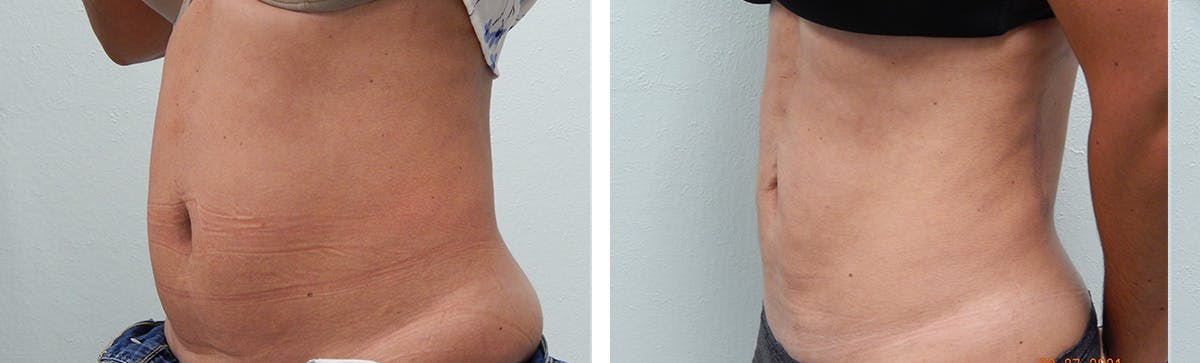 Liposuction Before & After Gallery - Patient 335932 - Image 4