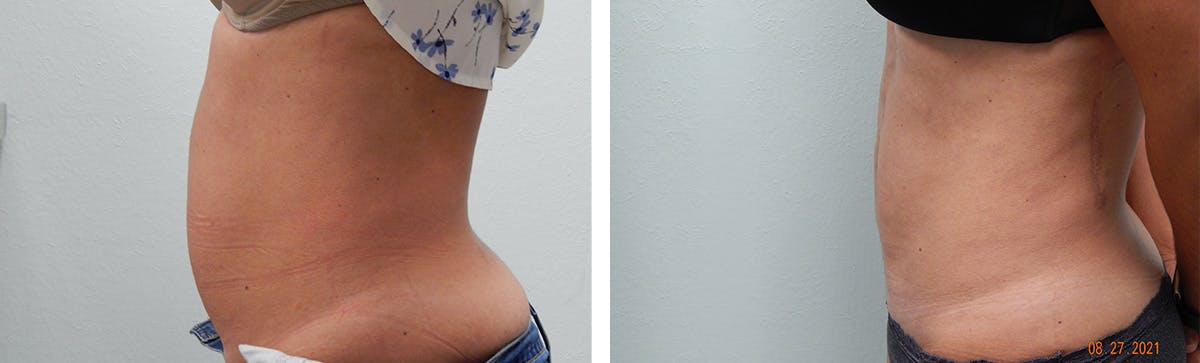 Liposuction Before & After Gallery - Patient 335932 - Image 5