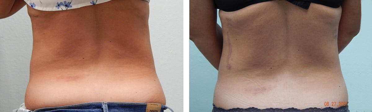 Liposuction Before & After Gallery - Patient 335932 - Image 6