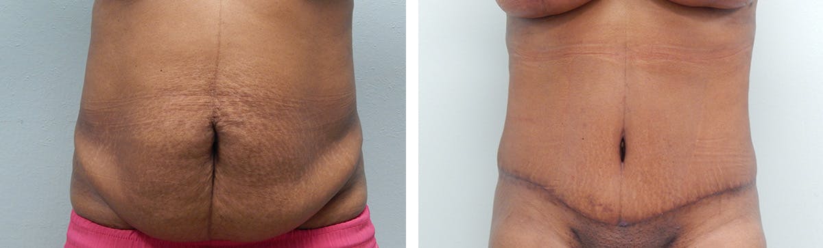 Tummy Tuck Before & After Gallery - Patient 175416 - Image 1