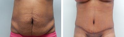 Liposuction Before & After Gallery - Patient 300533 - Image 1