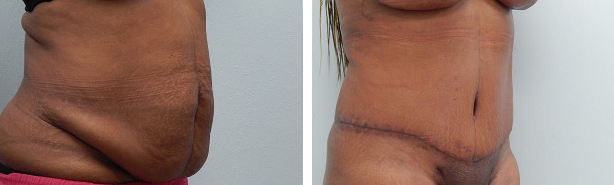 Tummy Tuck Before & After Gallery - Patient 175416 - Image 2