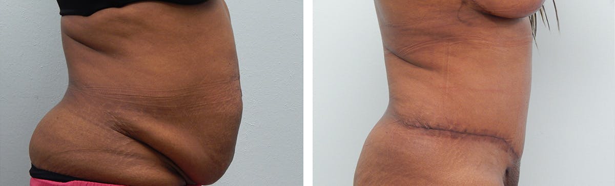 Liposuction Before & After Gallery - Patient 300533 - Image 3